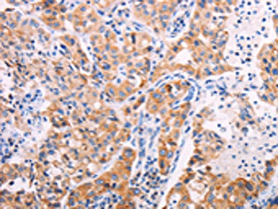 The image on the left is immunohistochemistry of paraffin-embedded Human lung cancer tissue using TEKT4 Antibody(TEKT4 Antibody) at dilution 1/20, on the right is treated with fusion protein. (Original magnification: ×200)Rabbit anti-Human TEKT4 Polyclonal Antibody