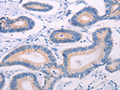 The image on the left is immunohistochemistry of paraffin-embedded Human colon cancer tissue using the antibody Antibody) at dilution 1/20, on the right is treated with fusion protein. (Original magnification: ×200)Rabbit anti-Human TEKT4 Polyclonal Antibody