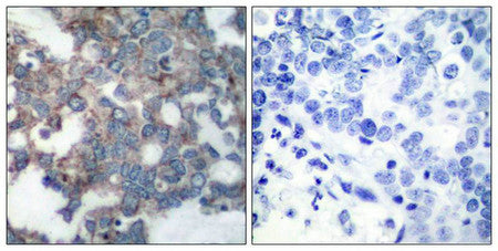 Immunohistochemical analysis of paraffin-embedded human breast carcinoma tissue using p70 S6 Kinase(Phospho-Ser424) Antibody(left) or the same antibody preincubated with blocking peptide(right).Rabbit anti-Human RPS6KB1 Polyclonal Antibody
