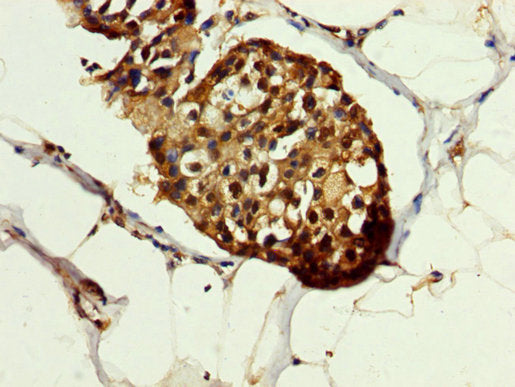 IHC image of HSPA1A Antibody diluted at 1:200 and staining in paraffin-embedded human breast cancer performed on a Leica BondTM system. After dewaxing and hydration, antigen retrieval was mediated by high pressure in a citrate buffer (pH 6.0). Section was blocked with 10% normal goat serum 30min at RT. Then primary antibody (1% BSA) was incubated at 4°C overnight. The primary is detected by a biotinylated secondary antibody and visualized using an HRP conjugated SP system.Rabbit anti-Human HSPA1A Polyclonal Antibody