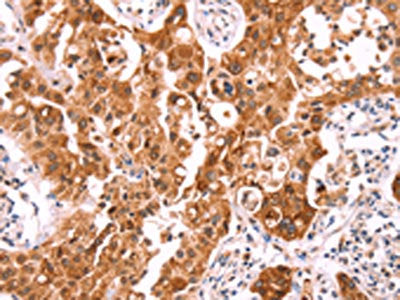 The image on the left is immunohistochemistry of paraffin-embedded Human lung cancer tissue using NCEH1 Antibody(NCEH1 Antibody) at dilution 1/80, on the right is treated with fusion protein. (Original magnification: ×200)Rabbit anti-Human NCEH1 Polyclonal Antibody