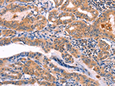 The image on the left is immunohistochemistry of paraffin-embedded Human thyroid cancer tissue using the antibody Antibody) at dilution 1/80, on the right is treated with fusion protein. (Original magnification: ×200)Rabbit anti-Human NCEH1 Polyclonal Antibody