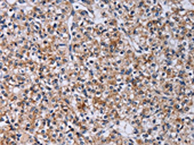 The image on the left is immunohistochemistry of paraffin-embedded Human prostate cancer tissue using CA4 Antibody(CA4 Antibody) at dilution 1/30, on the right is treated with fusion protein. (Original magnification: ×200)