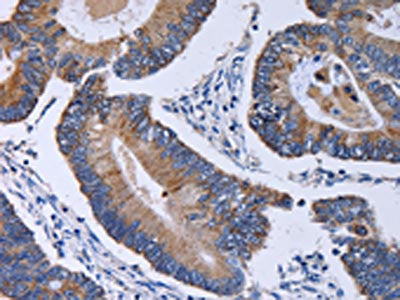 The image on the left is immunohistochemistry of paraffin-embedded Human colon cancer tissue using the antibody Antibody) at dilution 1/30, on the right is treated with fusion protein. (Original magnification: ×200)