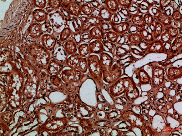 Immunohistochemical analysis of paraffin-embedded Human-kidney, antibody was diluted at 1:100Rabbit anti-Human EYA1/EYA4 Polyclonal Antibody