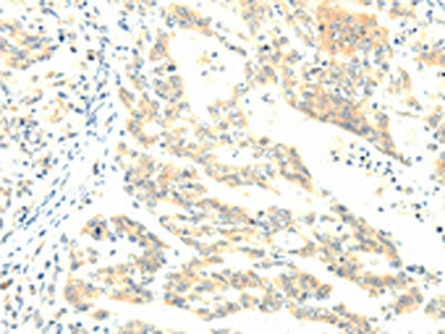 The image on the left is immunohistochemistry of paraffin-embedded Human gastric cancer tissue using TERF1 Antibody(TERF1 Antibody) at dilution 1/30, on the right is treated with fusion protein. (Original magnification: ×200)