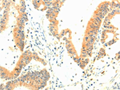 The image on the left is immunohistochemistry of paraffin-embedded Human colon cancer tissue using the antibody Antibody) at dilution 1/30, on the right is treated with fusion protein. (Original magnification: ×200)