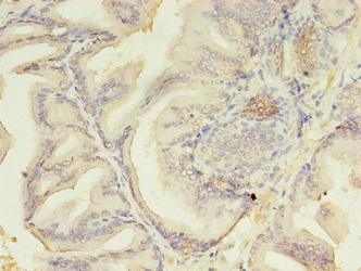 Immunohistochemistry of paraffin-embedded human prostate cancer using AZGP1 Antibody at dilution of 1:100