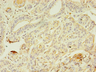 Immunohistochemistry of paraffin-embedded human breast cancer using AZGP1 Antibody at dilution of 1:100