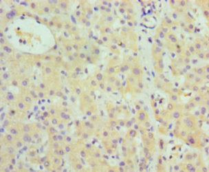 Immunohistochemistry of paraffin-embedded human liver cancer using CFB Antibody at dilution of 1:100Rabbit anti-Human CFB Polyclonal Antibody