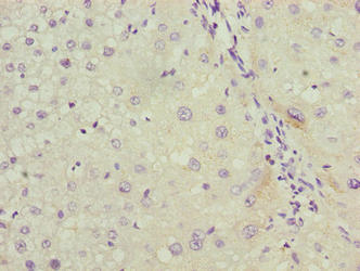 Immunohistochemistry of paraffin-embedded human liver cancer using LRG1 Antibody at dilution of 1:100
