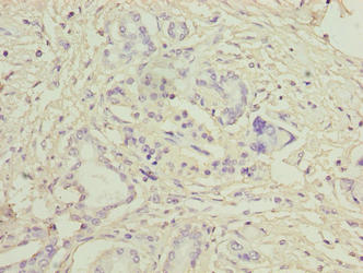 Immunohistochemistry of paraffin-embedded human pancreatic cancer using LRG1 Antibody at dilution of 1:100