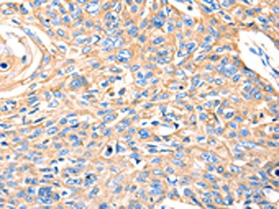 The image on the left is immunohistochemistry of paraffin-embedded Human esophagus cancer tissue using MVP Antibody(MVP Antibody) at dilution 1/30, on the right is treated with fusion protein. (Original magnification: ×200)Rabbit anti-Human MVP Polyclonal Antibody