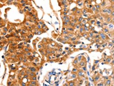 The image on the left is immunohistochemistry of paraffin-embedded Human lung cancer tissue using the antibody Antibody) at dilution 1/30, on the right is treated with fusion protein. (Original magnification: ×200)Rabbit anti-Human MVP Polyclonal Antibody