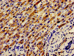 Immunohistochemistry of paraffin-embedded human liver cancer using APOH Antibody at dilution of 1:100Rabbit anti-Human APOH Polyclonal Antibody