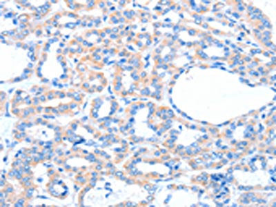 The image on the left is immunohistochemistry of paraffin-embedded Human thyroid cancer tissue using ACOX1 Antibody(ACOX1 Antibody) at dilution 1/20, on the right is treated with fusion protein. (Original magnification: ×200)