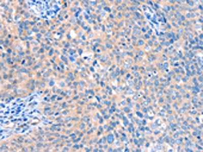 The image on the left is immunohistochemistry of paraffin-embedded Human cervical cancer tissue using the antibody Antibody) at dilution 1/20, on the right is treated with fusion protein. (Original magnification: ×200)