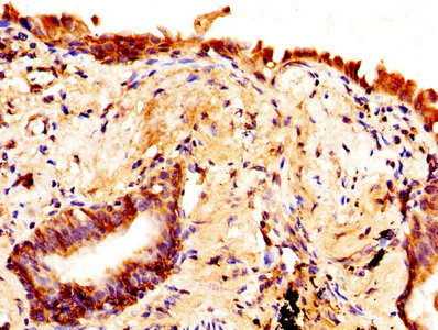 IHC image of AQP4 Antibody diluted at 1:370 and staining in paraffin-embedded human lung cancer performed on a Leica BondTM system. After dewaxing and hydration, antigen retrieval was mediated by high pressure in a citrate buffer (pH 6.0). Section was blocked with 10% normal goat serum 30min at RT. Then primary antibody (1% BSA) was incubated at 4°C overnight. The primary is detected by a biotinylated secondary antibody and visualized using an HRP conjugated SP system.Rabbit anti-Human AQP4 Polyclonal Antibody