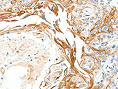 The image on the left is immunohistochemistry of paraffin-embedded Human esophagus cancer tissue using PLAT Antibody(PLAT Antibody) at dilution 1/50, on the right is treated with synthetic peptide. (Original magnification: ×200)Rabbit anti-Human PLAT Polyclonal Antibody