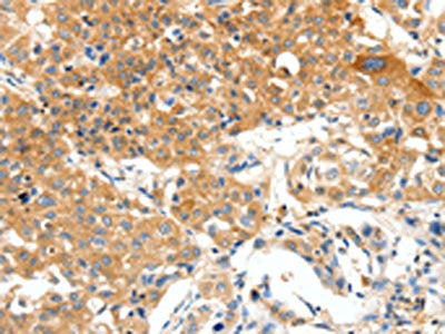 The image on the left is immunohistochemistry of paraffin-embedded Human lung cancer tissue using the antibody Antibody) at dilution 1/50, on the right is treated with synthetic peptide. (Original magnification: ×200)Rabbit anti-Human PLAT Polyclonal Antibody