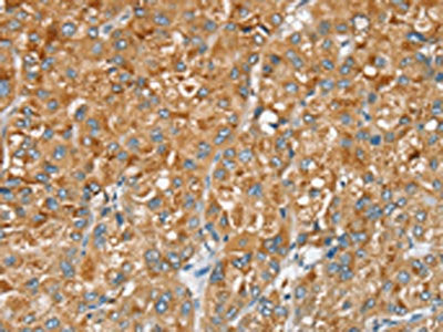 The image on the left is immunohistochemistry of paraffin-embedded Human liver cancer tissue using the antibody Antibody) at dilution 1/20, on the right is treated with synthetic peptide. (Original magnification: ×200)Rabbit anti-Human SERINC2 Polyclonal Antibody