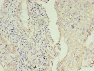 Immunohistochemistry of paraffin-embedded human lung cancer using KRT8 Antibody at dilution of 1:100