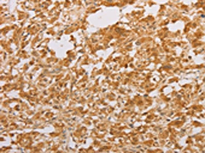 The image on the left is immunohistochemistry of paraffin-embedded Human thyroid cancer tissue using STK40 Antibody(STK40 Antibody) at dilution 1/30, on the right is treated with fusion protein. (Original magnification: ×200)Rabbit anti-Human STK40 Polyclonal Antibody