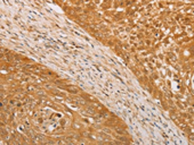 The image on the left is immunohistochemistry of paraffin-embedded Human cervical cancer tissue using the antibody Antibody) at dilution 1/30, on the right is treated with fusion protein. (Original magnification: ×200)Rabbit anti-Human STK40 Polyclonal Antibody