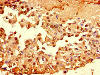 Immunohistochemistry of paraffin-embedded human breast cancer using the antibody at dilution of 1:100Rabbit anti-Human MUC1 Polyclonal Antibody