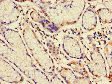 Immunohistochemistry of paraffin-embedded human gastric cancer using MUC1 Antibody at dilution of 1:100Rabbit anti-Human MUC1 Polyclonal Antibody