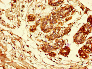 Immunohistochemistry of paraffin-embedded human breast cancer using the antibody at dilution of 1:100Rabbit anti-Human AREG Polyclonal Antibody