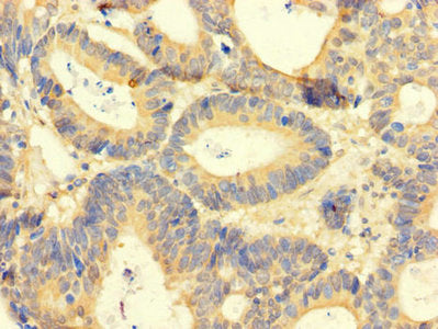 Immunohistochemistry of paraffin-embedded human colon cancer using AREG Antibody at dilution of 1:100Rabbit anti-Human AREG Polyclonal Antibody