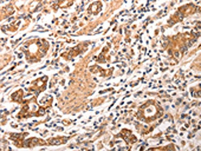The image is immunohistochemistry of paraffin-embedded human gastric cancer tissue using CCL17 Antibody(CCL17 Antibody) at dilution 1/70. (Original magnification: ×200)Rabbit anti-Human CCL17 Polyclonal Antibody