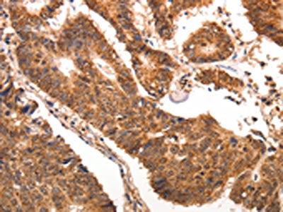The image is immunohistochemistry of paraffin-embedded human colon cancer tissue using the antibody Antibody) at dilution 1/70. (Original magnification: ×200)