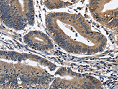 The image on the left is immunohistochemistry of paraffin-embedded Human colon cancer tissue using IL2RB Antibody(IL2RB Antibody) at dilution 1/60, on the right is treated with fusion protein. (Original magnification: ×200)Rabbit anti-Human IL2RB Polyclonal Antibody