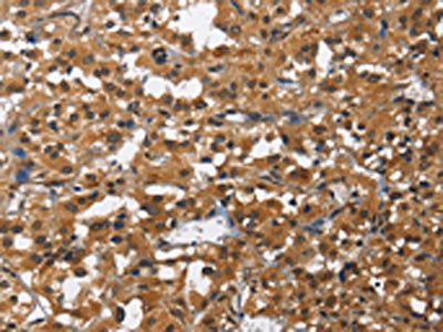 The image on the left is immunohistochemistry of paraffin-embedded Human thyroid cancer tissue using the antibody Antibody) at dilution 1/60, on the right is treated with fusion protein. (Original magnification: ×200)Rabbit anti-Human IL2RB Polyclonal Antibody