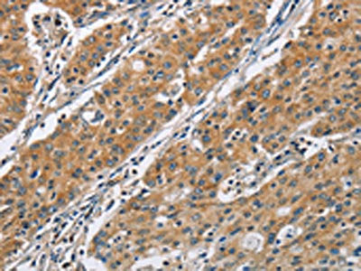 The image on the left is immunohistochemistry of paraffin-embedded Human gastric cancer tissue using COPB1 Antibody(COPB1 Antibody) at dilution 1/50, on the right is treated with fusion protein. (Original magnification: ×200)Rabbit anti-Human COPB1 Polyclonal Antibody