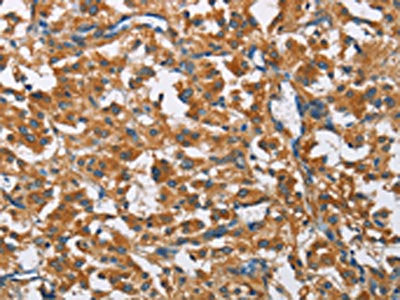 The image on the left is immunohistochemistry of paraffin-embedded Human thyroid cancer tissue using the antibody Antibody) at dilution 1/50, on the right is treated with fusion protein. (Original magnification: ×200)Rabbit anti-Human COPB1 Polyclonal Antibody