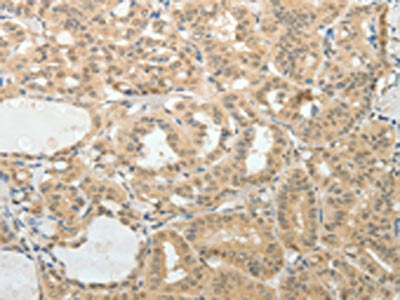 The image on the left is immunohistochemistry of paraffin-embedded Human thyroid cancer tissue using AFF2 Antibody(AFF2 Antibody) at dilution 1/25, on the right is treated with synthetic peptide. (Original magnification: ×200)Rabbit anti-Human AFF2 Polyclonal Antibody