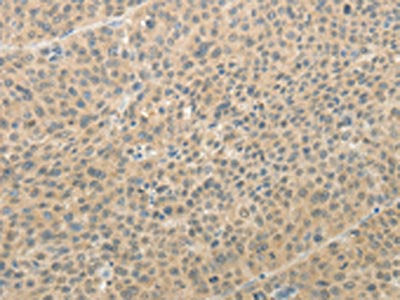 The image on the left is immunohistochemistry of paraffin-embedded Human liver cancer tissue using the antibody Antibody) at dilution 1/25, on the right is treated with synthetic peptide. (Original magnification: ×200)
