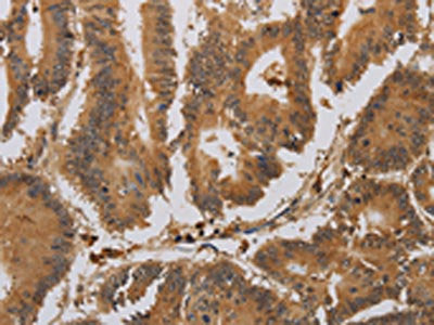 The image on the left is immunohistochemistry of paraffin-embedded Human colon cancer tissue using ACHE Antibody(ACHE Antibody) at dilution 1/20, on the right is treated with synthetic peptide. (Original magnification: X200)