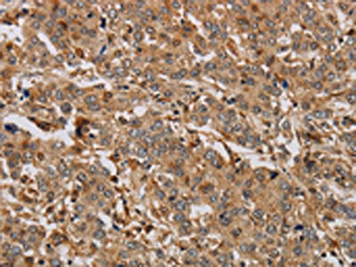 The image on the left is immunohistochemistry of paraffin-embedded Human liver cancer tissue using the antibody Antibody) at dilution 1/20, on the right is treated with synthetic peptide. (Original magnification: X200)