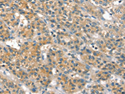 The image on the left is immunohistochemistry of paraffin-embedded Human liver cancer tissue using PPP2CA Antibody(PPP2CA Antibody) at dilution 1/35, on the right is treated with fusion protein. (Original magnification: ×200)Rabbit anti-Human PPP2CA Polyclonal Antibody