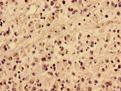 Immunohistochemistry of paraffin-embedded human glioma using COL4A1 Antibody at dilution of 1:100Rabbit anti-Human COL4A1 Polyclonal Antibody