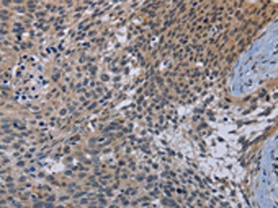 The image on the left is immunohistochemistry of paraffin-embedded Human cervical cancer tissue using CDC16 Antibody(CDC16 Antibody) at dilution 1/50, on the right is treated with synthetic peptide. (Original magnification: ×200)Rabbit anti-Human CDC16 Polyclonal Antibody