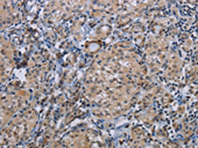 The image on the left is immunohistochemistry of paraffin-embedded Human thyroid cancer tissue using the antibody Antibody) at dilution 1/50, on the right is treated with synthetic peptide. (Original magnification: ×200)Rabbit anti-Human CDC16 Polyclonal Antibody