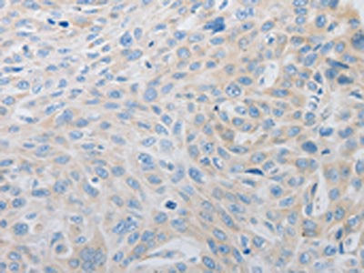The image on the left is immunohistochemistry of paraffin-embedded Human esophagus cancer tissue using PDX1 Antibody(PDX1 Antibody) at dilution 1/30, on the right is treated with synthetic peptide. (Original magnification: ×200)Rabbit anti-Human PDX1 Polyclonal Antibody