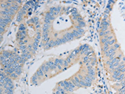 The image on the left is immunohistochemistry of paraffin-embedded Human colon cancer tissue using the antibody Antibody) at dilution 1/30, on the right is treated with synthetic peptide. (Original magnification: ×200)Rabbit anti-Human PDX1 Polyclonal Antibody