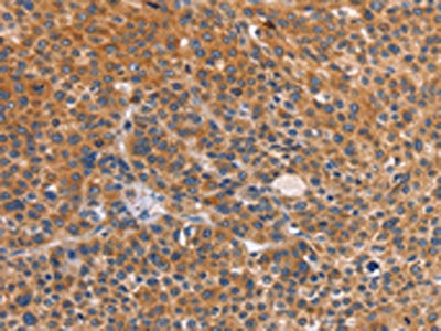The image on the left is immunohistochemistry of paraffin-embedded Human liver cancer tissue using CTSC Antibody(CTSC Antibody) at dilution 1/50, on the right is treated with synthetic peptide. (Original magnification: ×200)Rabbit anti-Human CTSC Polyclonal Antibody