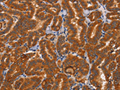 The image on the left is immunohistochemistry of paraffin-embedded Human thyroid cancer tissue using the antibody Antibody) at dilution 1/50, on the right is treated with synthetic peptide. (Original magnification: ×200)Rabbit anti-Human CTSC Polyclonal Antibody